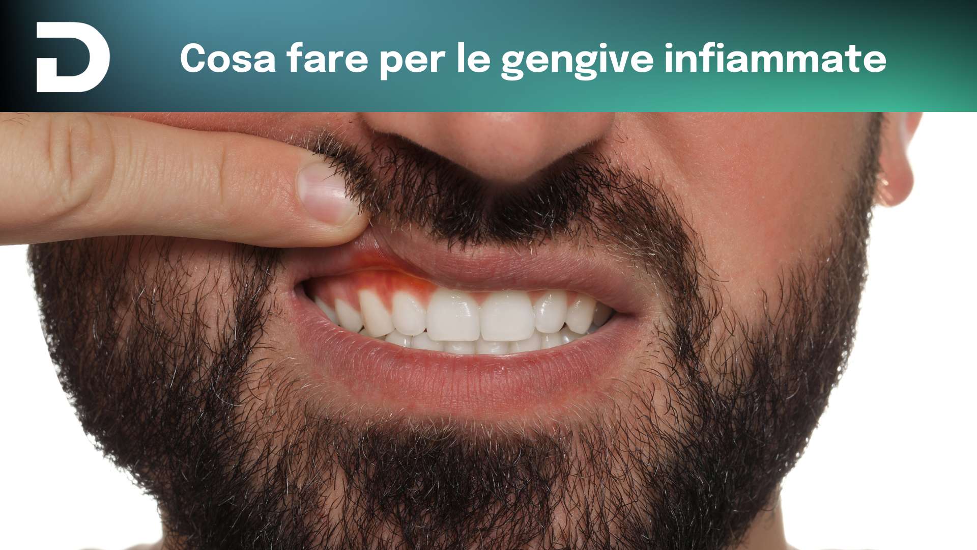 cosa fare per le gengive infiammate | dentalian