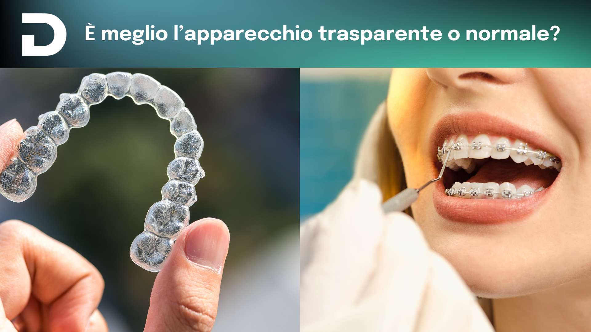 è meglio l’apparecchio trasparente o normale | dentalian