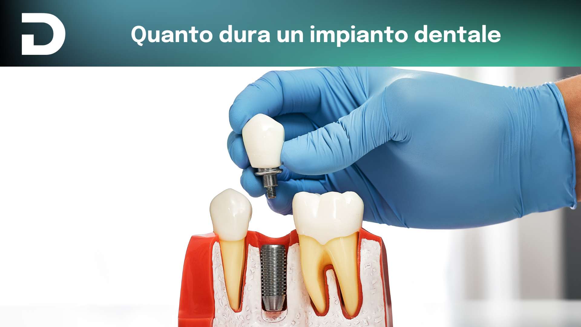 quanto dura un impianto dentale | dentalian