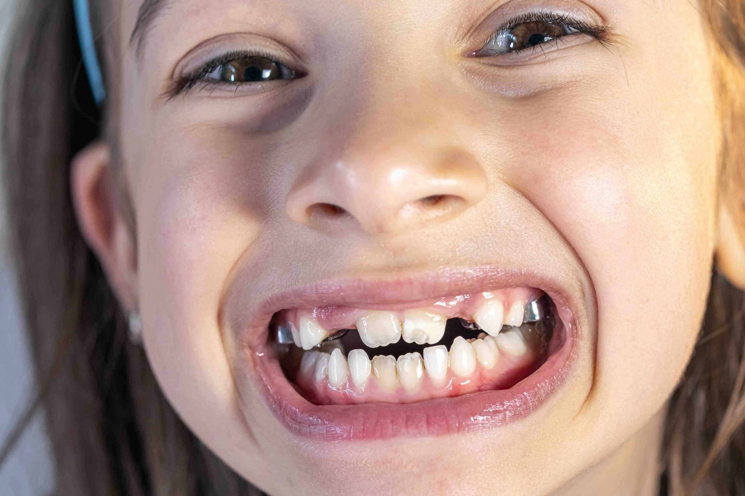 denti da latte che non cadono